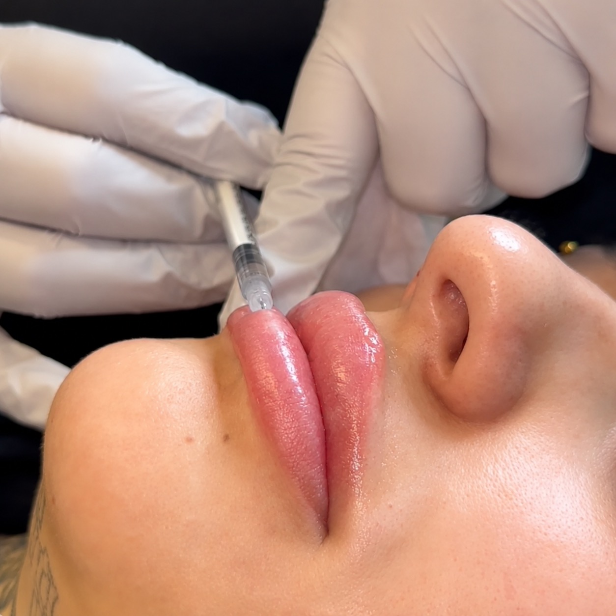 Lip filler injection treatment at Beauty Bar Aesthetics in Phoenix